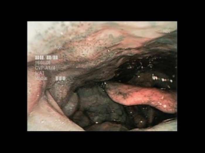 ＜中咽頭癌（口蓋垂－右軟口蓋）＞NBI
